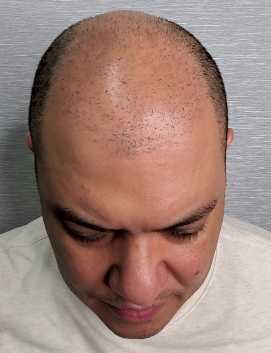 Scalp micro pigmentation treatment