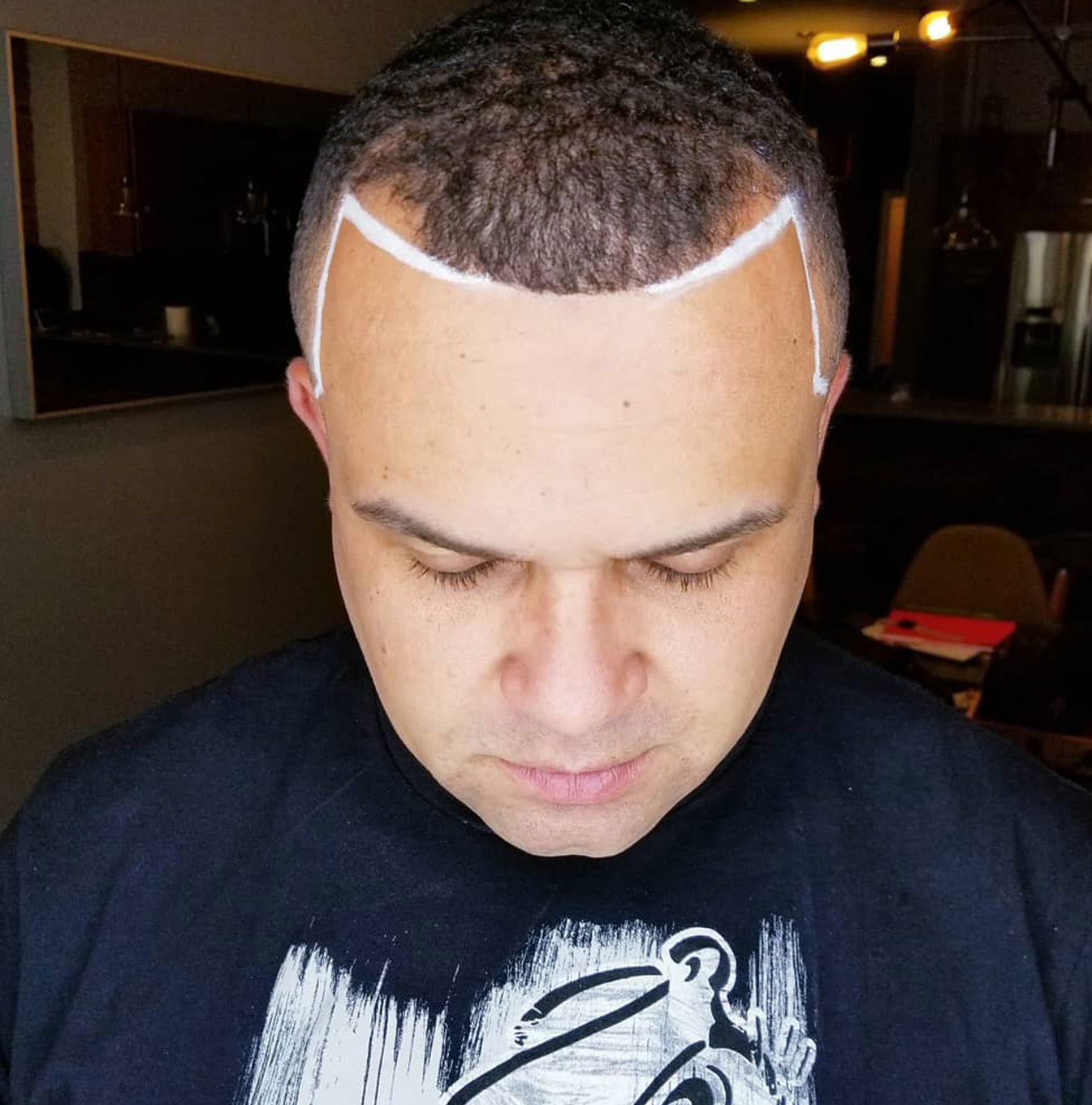 Scalp micro pigmentation treatment results